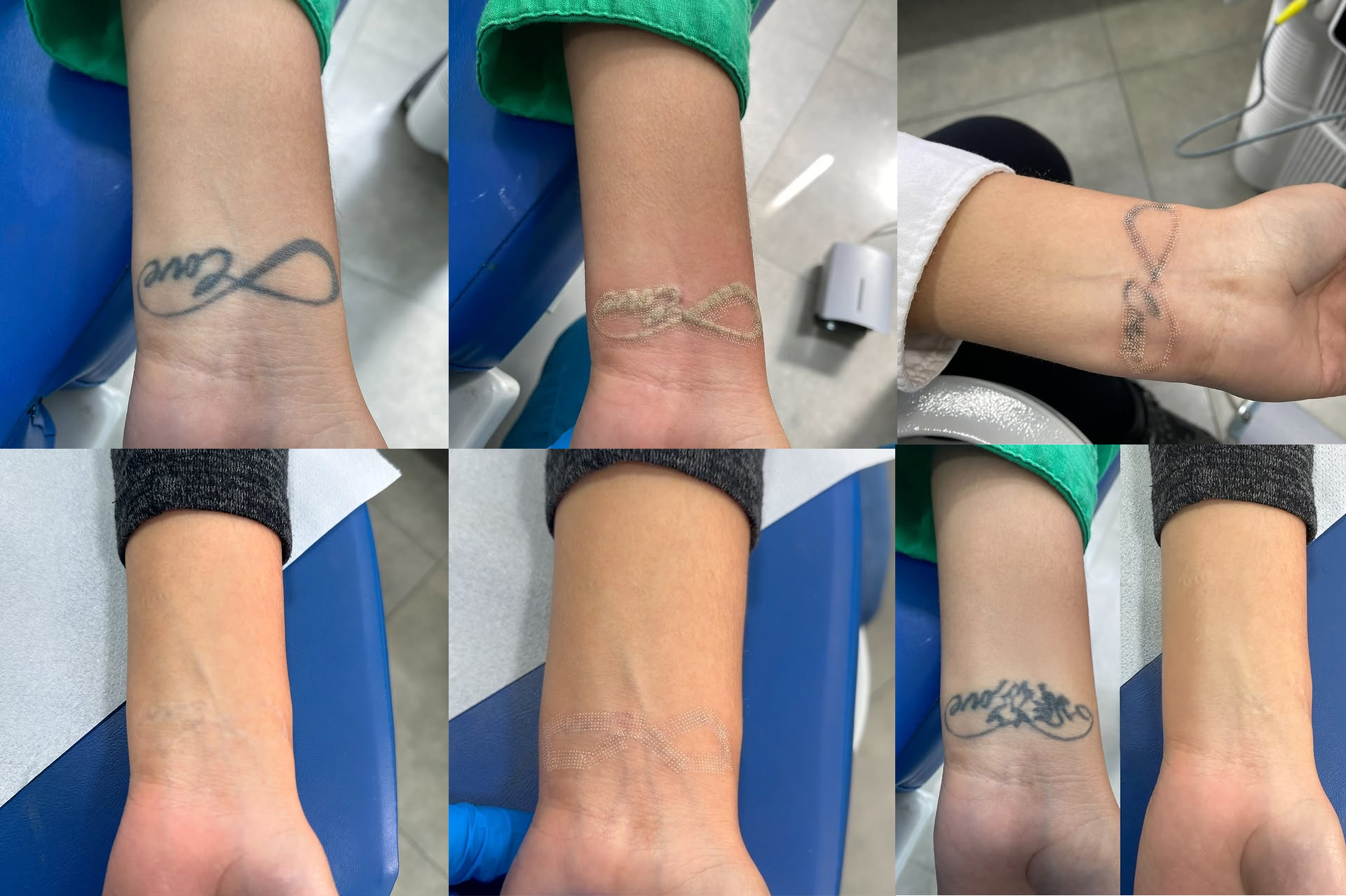 Tattoo Removal Mumbai