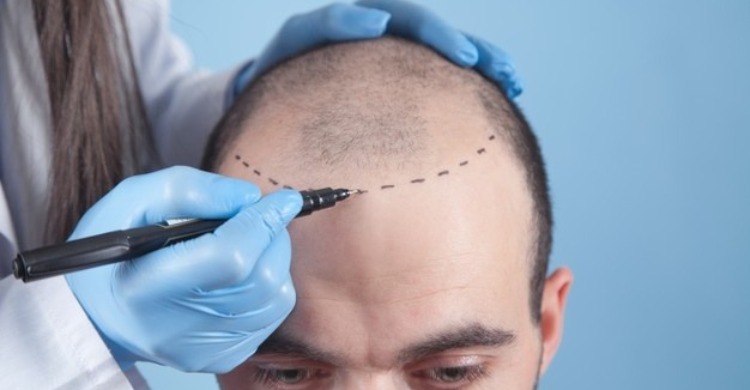 Hair Transplant
