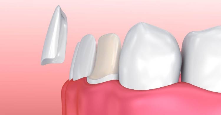 Dental Venners