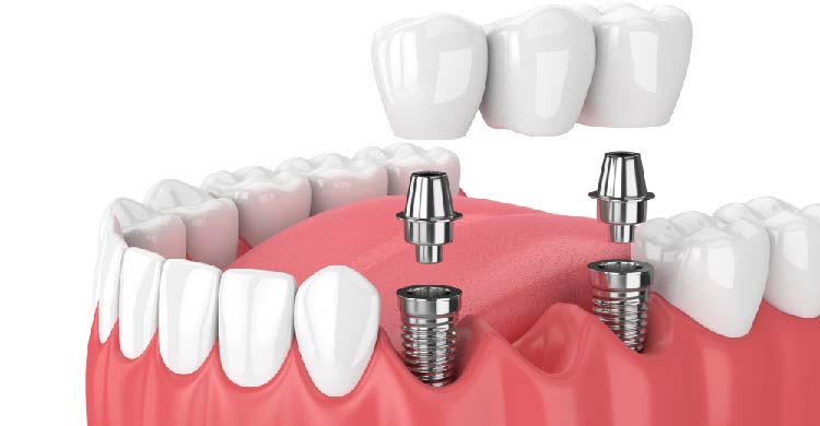 Dental Implants Treatment