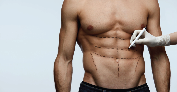 Six Pack Abs Liposuction