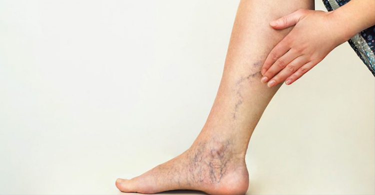Varicose Vein Treatment